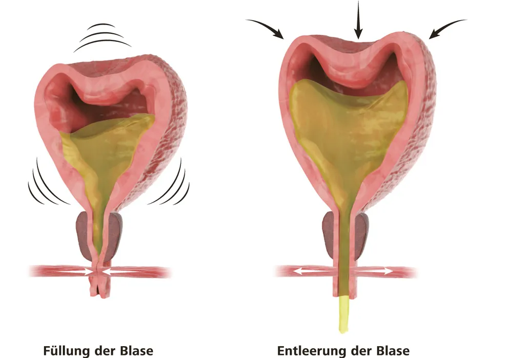 Blasenfüllung