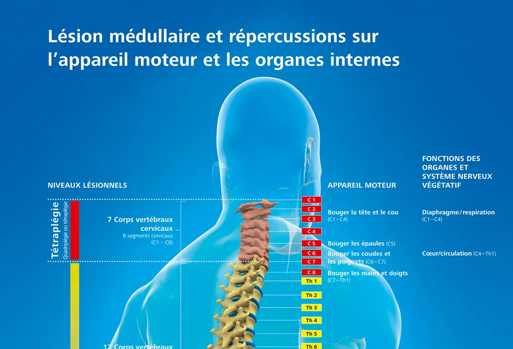 tetraplegie