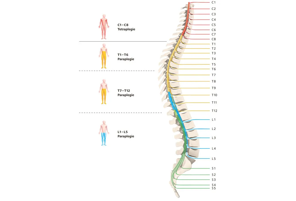 Wirbelsäule unterteilt in Para- und Tetraplegie